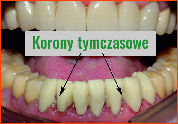 Protetyka Stomatologia ortopedyczna Warszawa PaNa klinica